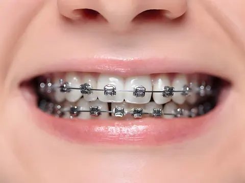 Close-up of a smile with metal braces on the top and bottom teeth