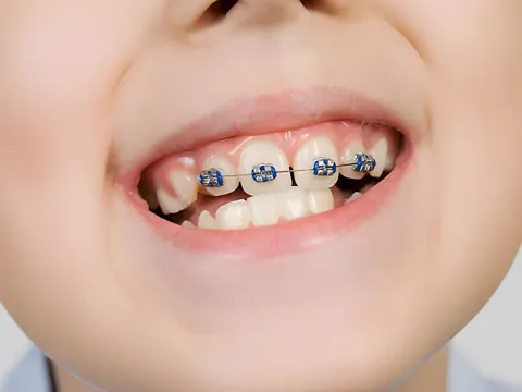 Close-up of a child smiling with blue-colored braces on the front teeth