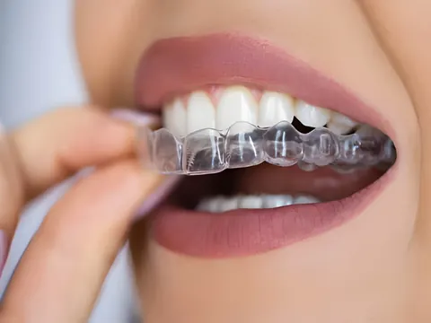 Close-up of a clear aligner being fitted over the top teeth